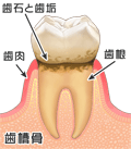 歯周病の進行2